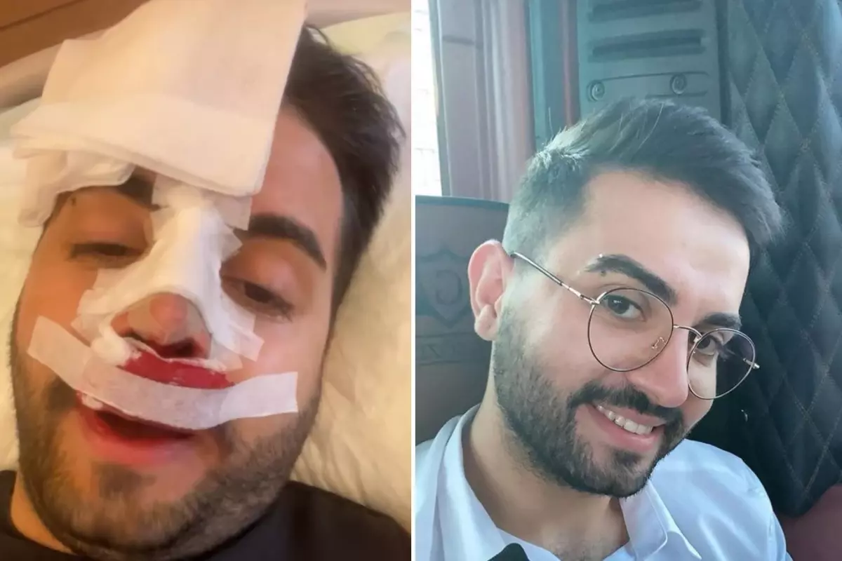 Kadir Ezildi'nin Burun Sargılı Fotoğrafı Yanlış Anlaşıldı: Gerçek 2020 Ameliyatı Açıklandı