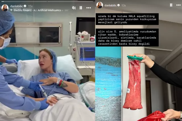 Operasyon sonrası dolgu maddesi örneği