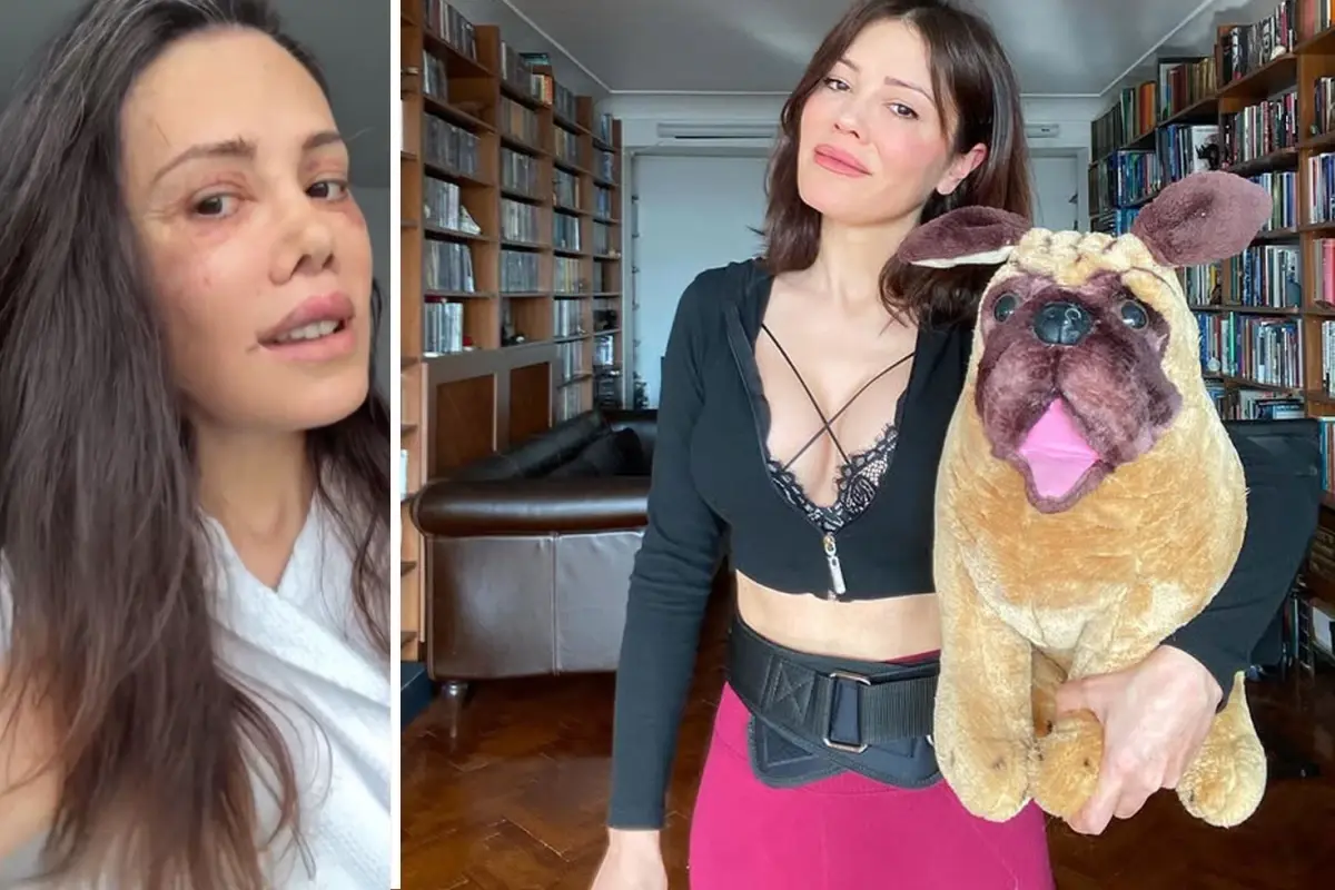 Didem Ceran, Yüz Estetiği Sonrası İlk Banyosunu Paylaştı: 19 Günlük İyileşme Süreci